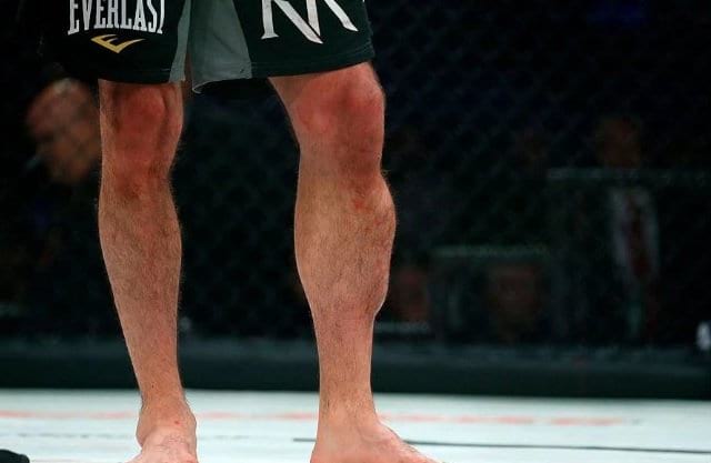 Rory MacDonald's shin after Bellator 192 his fight with Douglas Lima at Bellator 